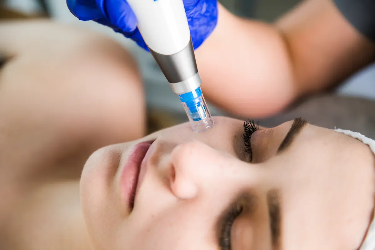 Dermapen 4.0 — wszystko, co warto wiedzieć