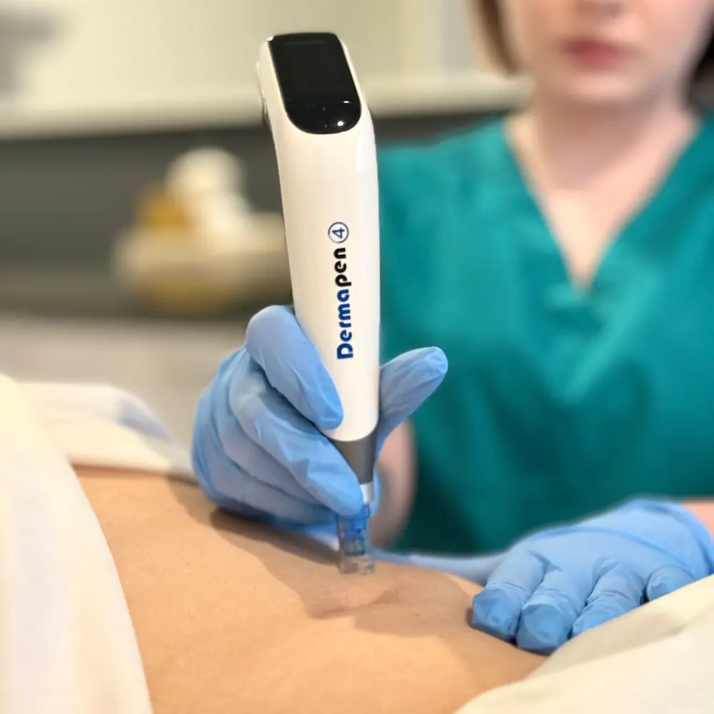Dermapen 4.0 — odmładzanie skóry